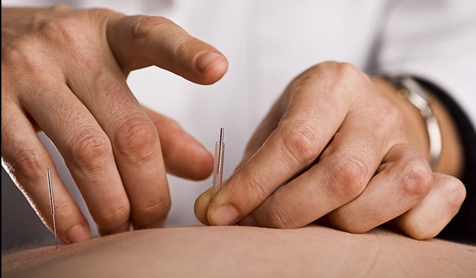 Acupuncture for Pain Relief